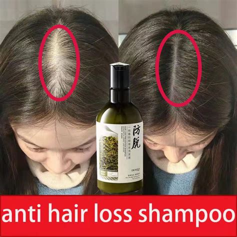 Anti Hair Loss Shampoo Anti Dandruff And Anti Itch Shampoo Anti Hair Loss And Strong Root