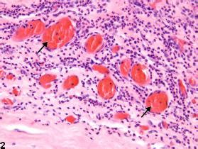 Eye, Cornea - Neovascularization - Nonneoplastic Lesion Atlas