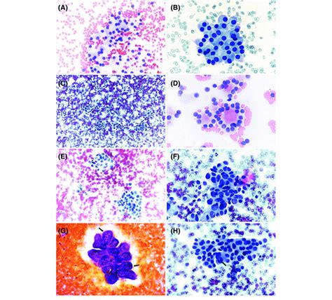 Representative Cytologic Images Of Different Thyroid Fine Needle