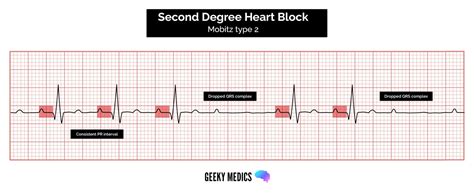 Atrioventricular Block Heart Block Geeky Medics