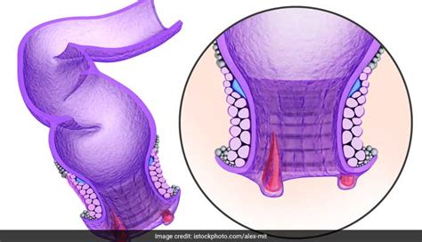 All You Need To Know About Anal Fissure