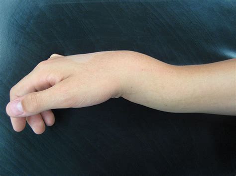 Gym Pain? Protecting the Hands and Wrists | Ladan Hajipour