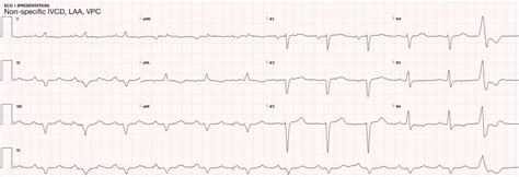 Differential Diagnosis Of Nonsustained Ventricular Tachycardia