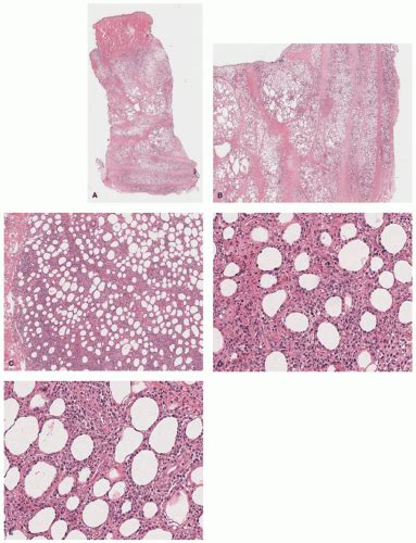 Cutaneous Hematolymphoid Proliferations Plastic Surgery Key