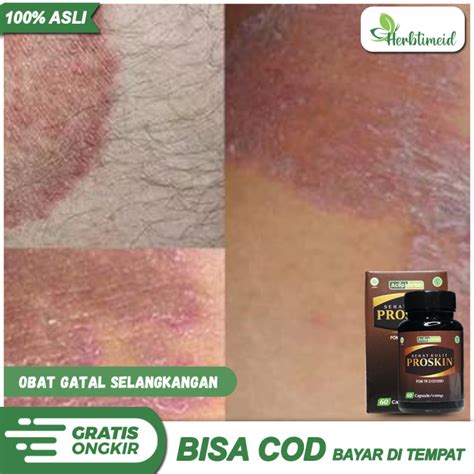 Kapsul Sehat Kulit Proskin Obat Herbal Untuk Gatal Gatal Di