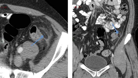 Epiploic Appendagitis