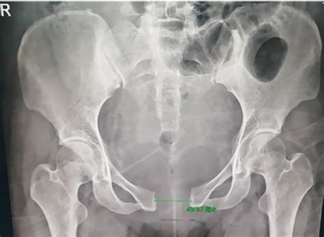 Figure 2 From Role Of Relaxin In Diastasis Of The Pubic Symphysis Peripartum Semantic Scholar