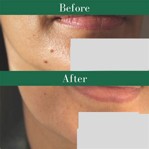 Learn Everything About Mole Removal On Face