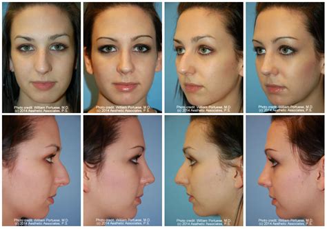 Crooked Nasal Bones Before And After Photo Gallery Nose Surgery Photos