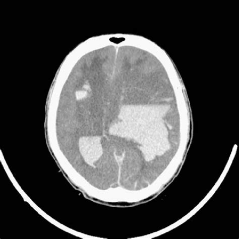 A Non Contrast Computed Tomography Image Of The Head Revealed Bilateral Download Scientific