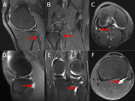 MRI images of the knees of normal people and of patients with popliteus... | Download Scientific ...