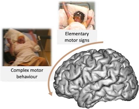 Frontal Lobe Seizure Fls Semiology Especially In Terms Of Motor