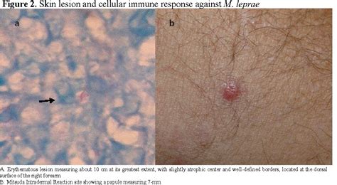 Figure 1 From Clinical Presentation Of Tuberculoid Leprosy In An