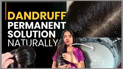 Dandruff Treatment At Home Dandruff Removal Percent Solution For