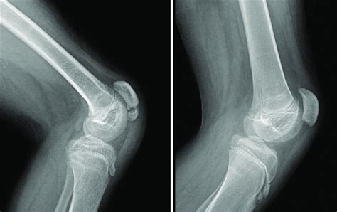 Lateral Radiographs Of The Knee Joint Showing Fragmentation Of The Download Scientific Diagram