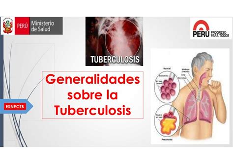 Atención A Las Personas Afectadas Con Tuberculosis 2015