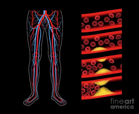 Peripheral Artery Disease Photograph By Pikovit Science Photo Library