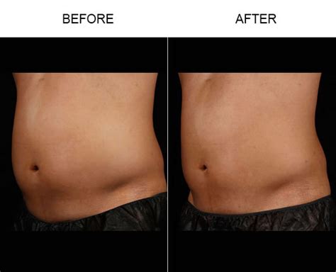 Laser Fat Removal Orlando | Laser Fat Reduction Florida