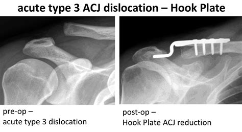 Fig 30 Acute Hook Plate Cambridge Shoulder