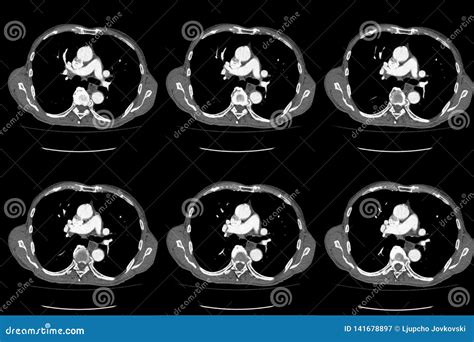 Computed Tomography Ct Whole Abdomen In Axial Part One Stock Image