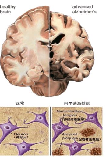 阿尔茨海默症是“不治之症”？基因检测可帮助早期发现患病风险apoe