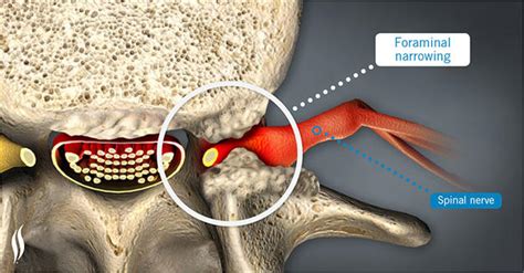 Pinched Nerve | Scottsdale, AZ Orthopedic Spine Surgery