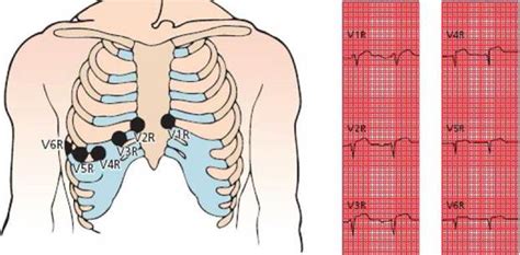 Myocardial Ischemia And Infarction The Only Ekg Book Th Ed