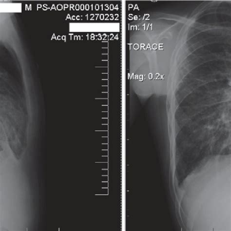 Posteroanterior And Lateral Chest X Ray Bilateral Interstitial