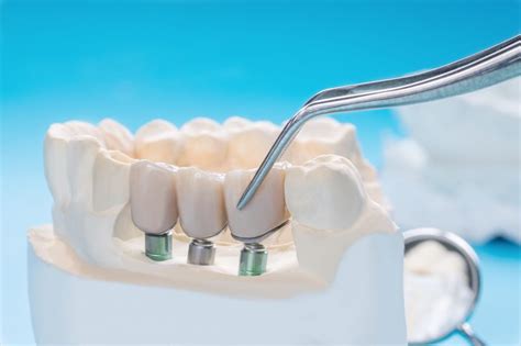 Qu Son Los Aditamentos Prot Sicos Cl Nica Dental Everest