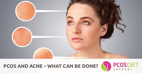 PCOS and Acne - What Can Be Done? | PCOS Diet Support