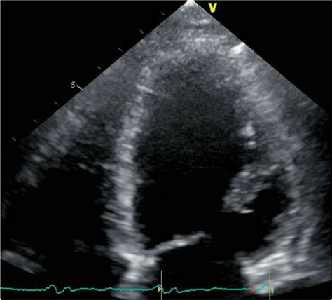 Echocardiogram Demonstrating Mildly Dilated Left Ventricle With An