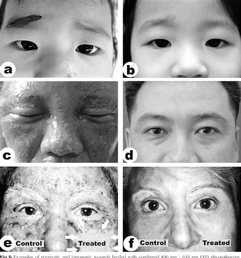 Figure From One Mechanism Behind Led Phototherapy For Wound Healing