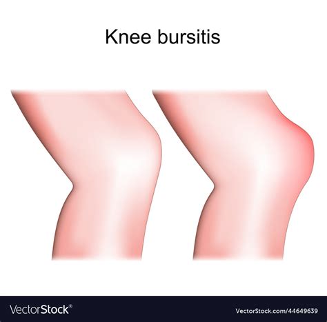 Knee bursitis prepatellar bursitis Royalty Free Vector Image