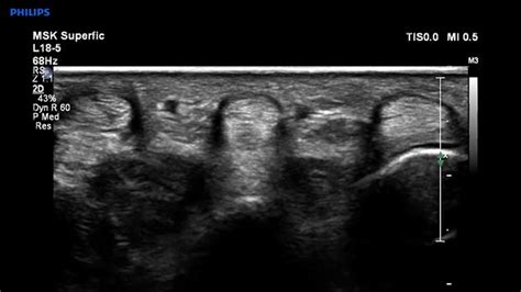 Musculoskeletal Ultrasound Resources Philips Healthcare