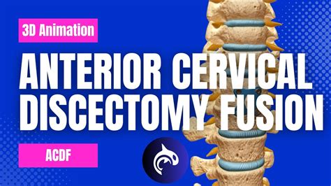 Anterior Cervical Discectomy And Fusion Acdf 3d Animation Youtube