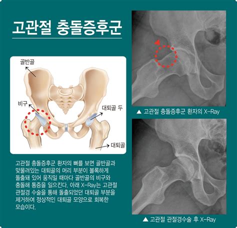 청․중년층 5명 중 1명 고관절 충돌증후군 위험