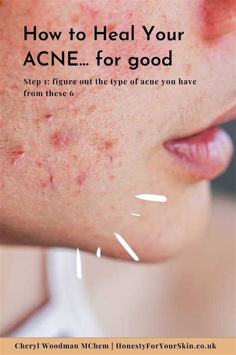 The 6 Different Types Of Acne Spots Plus Which Ones You Can Pick