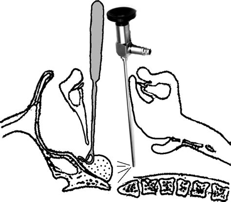 Trans Oral Endoscopic Partial Adenoidectomy Does Not Worsen The Speech After Cleft Palate Repair