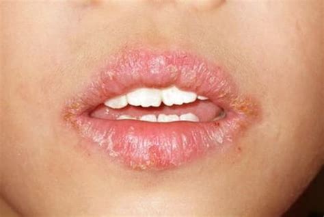 Angular Cheilitis Pictures Treatment Symptoms Causes HubPages