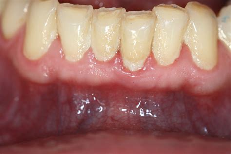 Gingivitis Zahnfleischentz Ndung Parodontitis