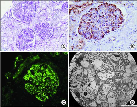 Renal Biopsy Findings A Glomerulonephritis With Download