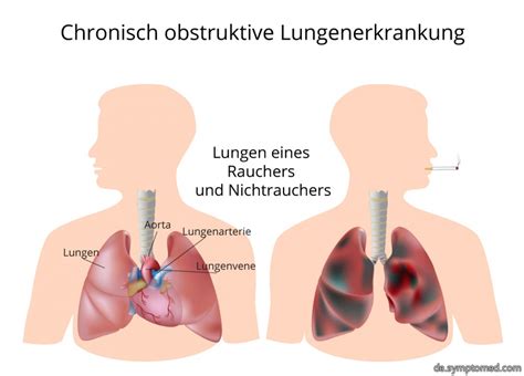 Chronisch Obstruktive Lungenerkrankung Symptome