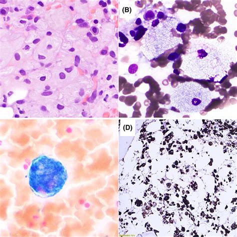 Photomicrograph Of The Bone Marrow Aspirate Smear Showing Gaucher Cells