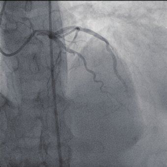 Antero Posterior AP Cranial View Showing Total Occlusion Of Mid Left