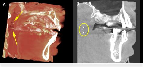 Tonsillar Stones In The Palatine Tonsils A Volumetric Rendering