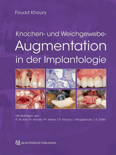 Knochen Und Weichgewebeaugmentation In Der Implantologie Buch Jpc