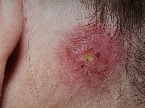 Staph Infection Types Symptoms Causes Treatments Medical News Today