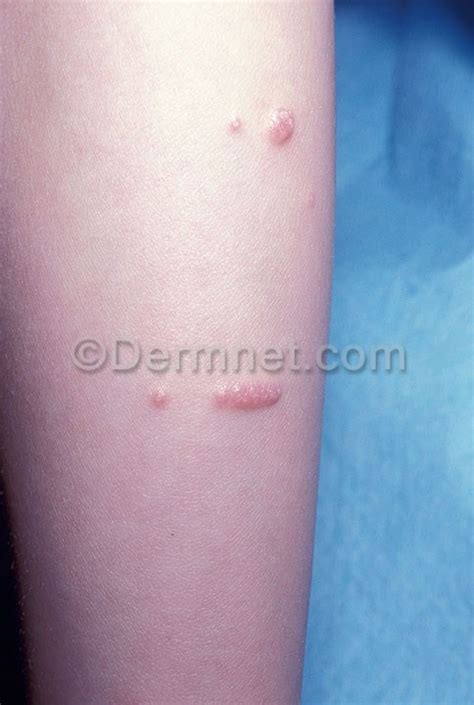 Molluscum Contagiosum Photo Skin Disease Pictures