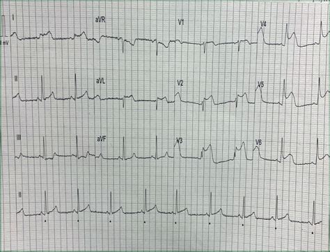 Journal Of Paramedic Practice Ecg Case Series For Paramedics October