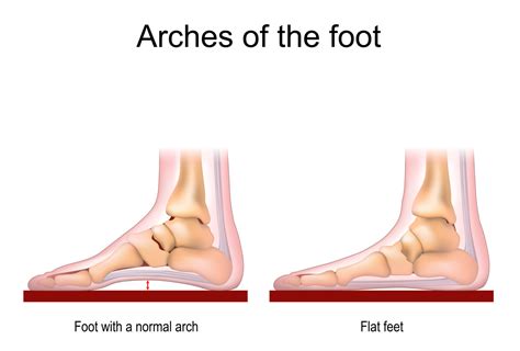 What Causes Flat Feet and How to Find Relief • Sensational Feet